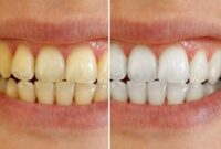 Dental Prophylaxis and Whitening Teeth